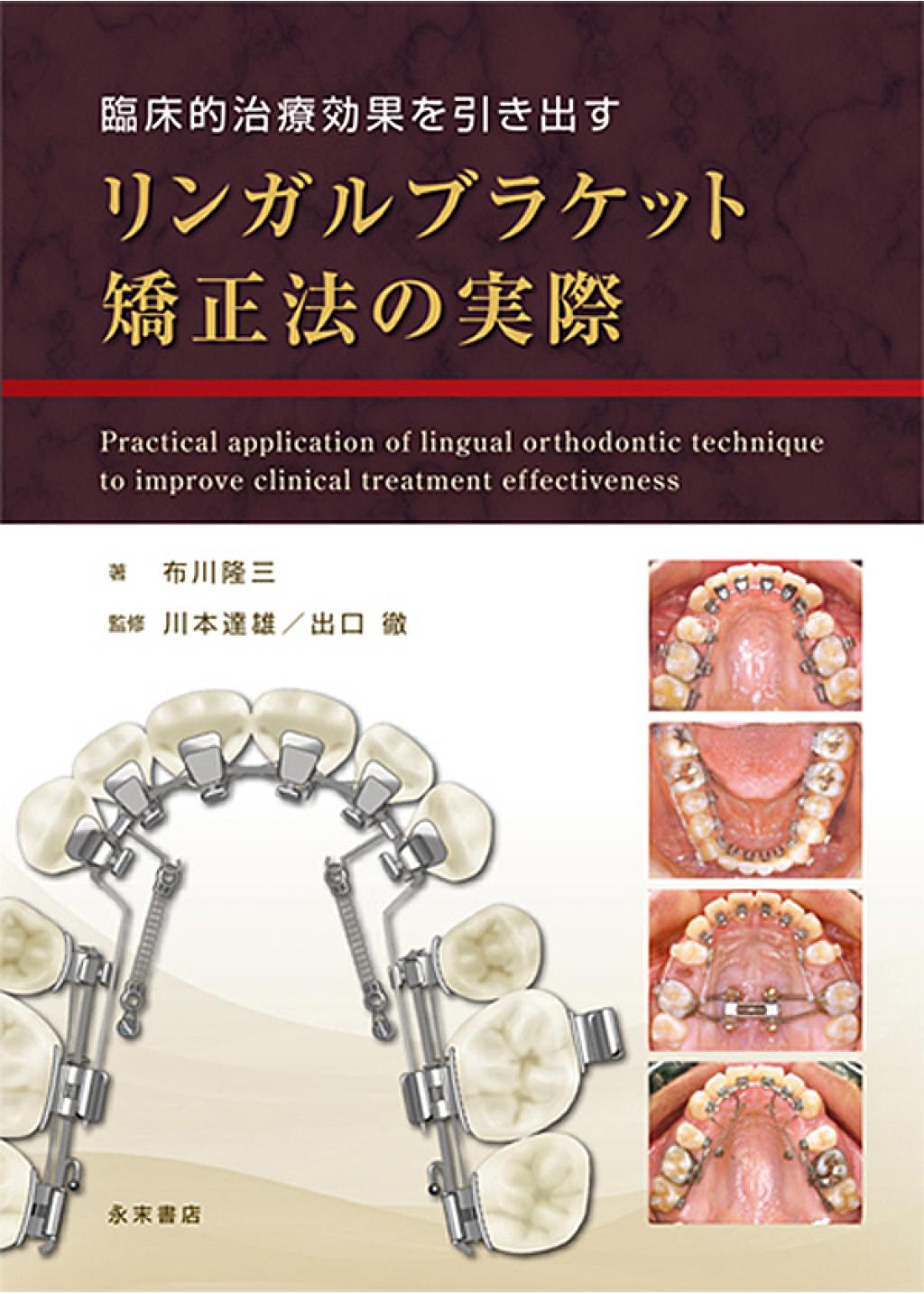 リンガルブラケット矯正法の実際の購入ならWHITE CROSS