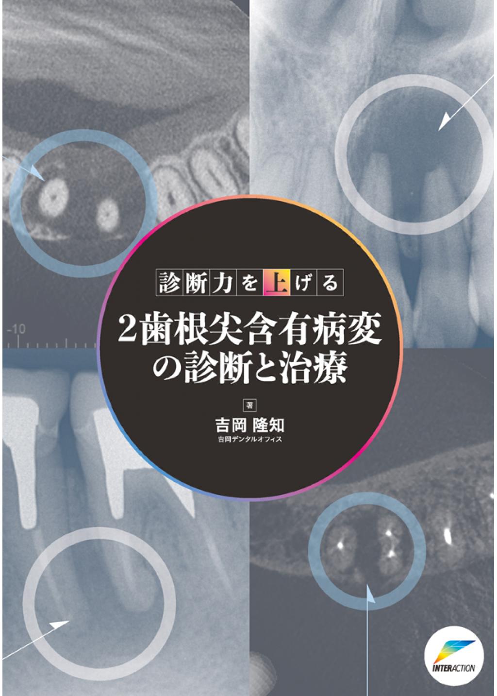 診断力を上げる ２歯根尖含有病変の診断と治療の購入ならWHITE CROSS