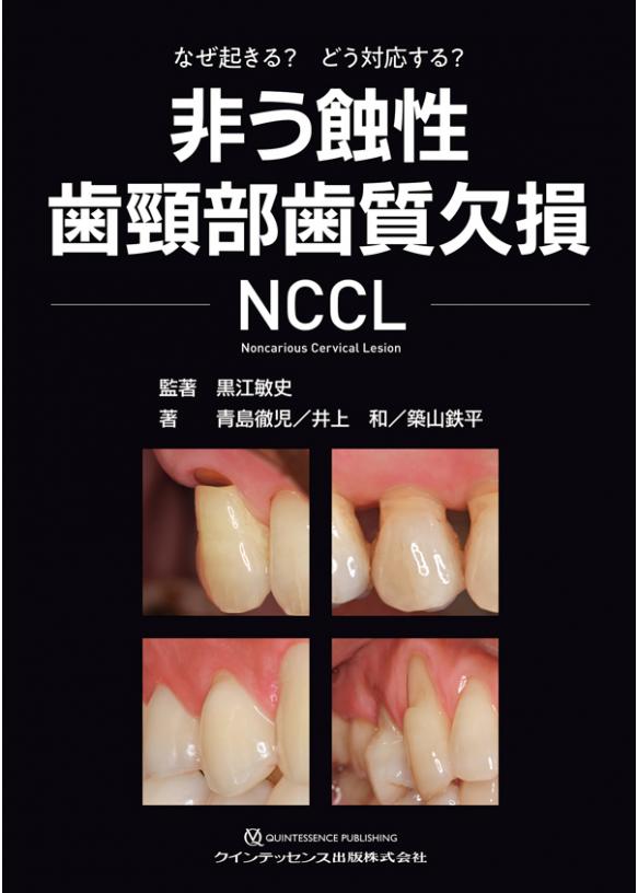 非う蝕性歯頸部歯質欠損 NCCLの画像です